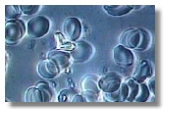 Uric Acid in Blood Sample